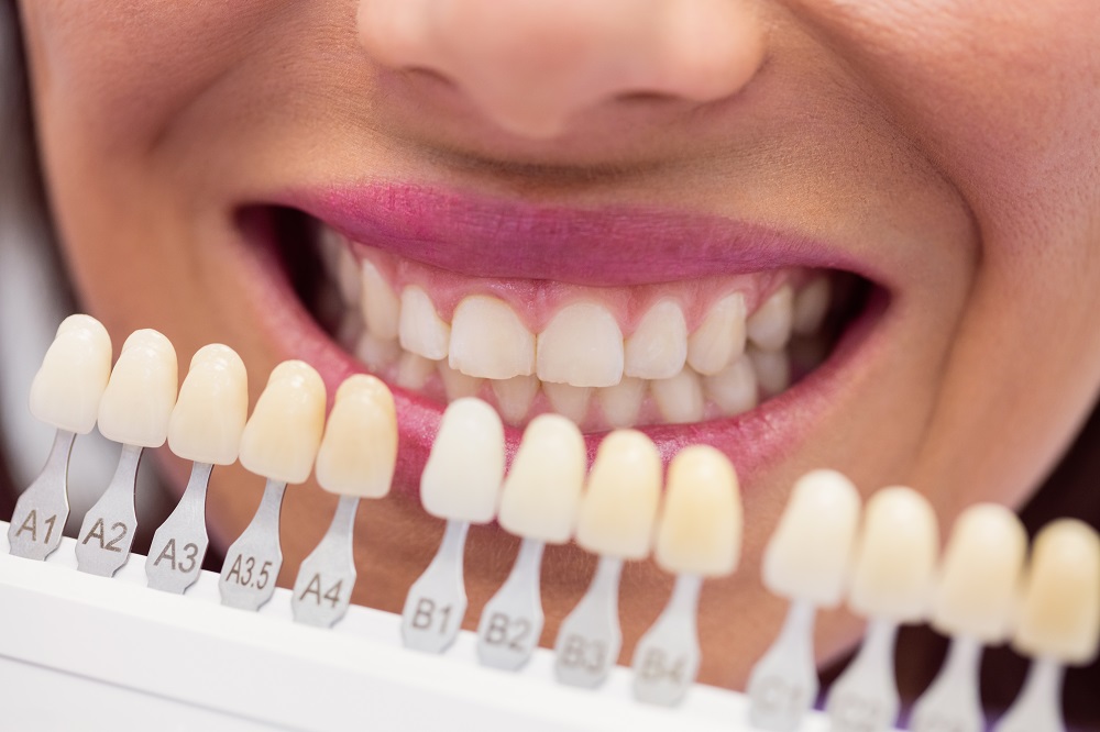 Veneers vs. Crowns